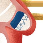 Implant.jpg Implant.jpg