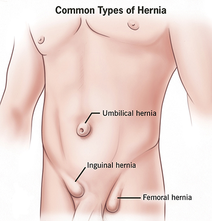 Common Types of Hernia (STOCK IMAGE) Common Types of Hernia