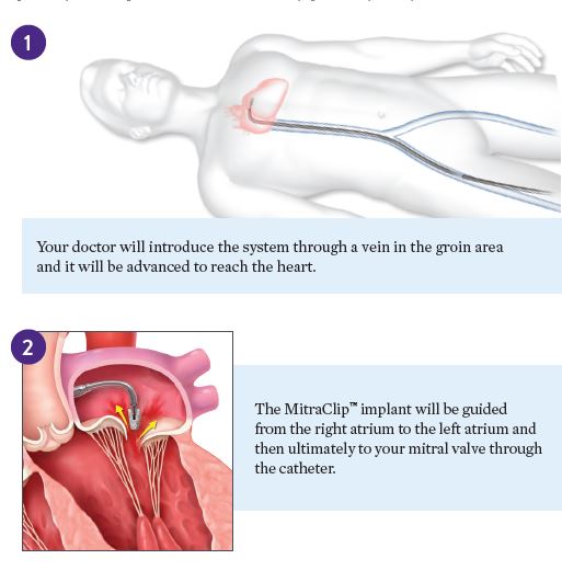 Procedure-1-2.JPG