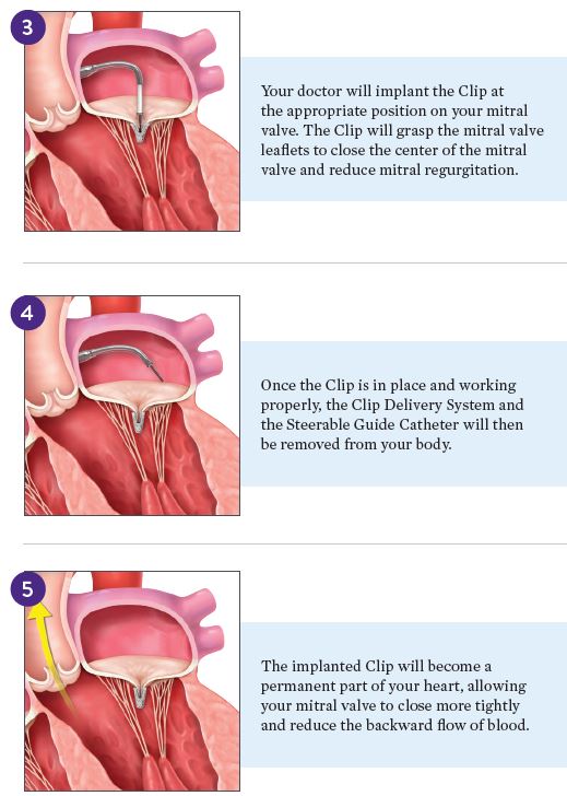 Procedure-345.JPG