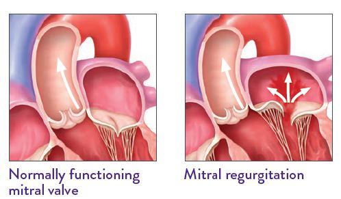 normal-mitral-valve-and-MR.JPG