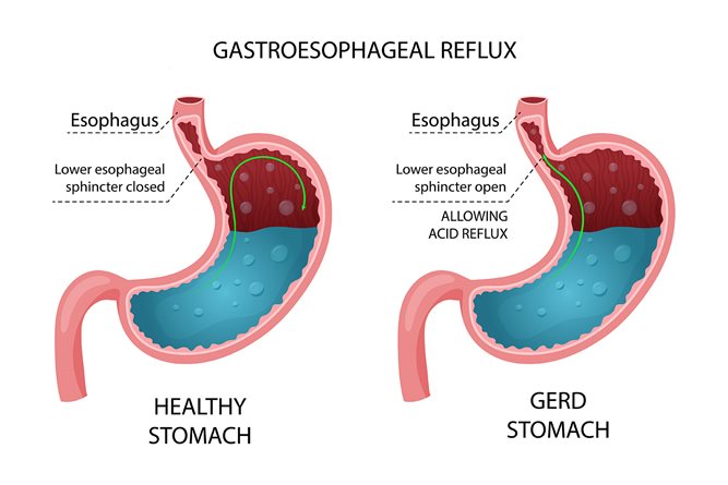 What does a GERD stomach look like compared to a healthy stomach? IMAGE-what-is-gerd