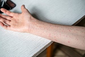 measles-arm-sm.jpg measles-arm-sm.jpg