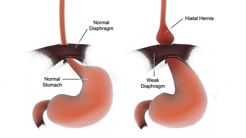 Heartburn/Hiatal Hernia Repair - Northern Light Health