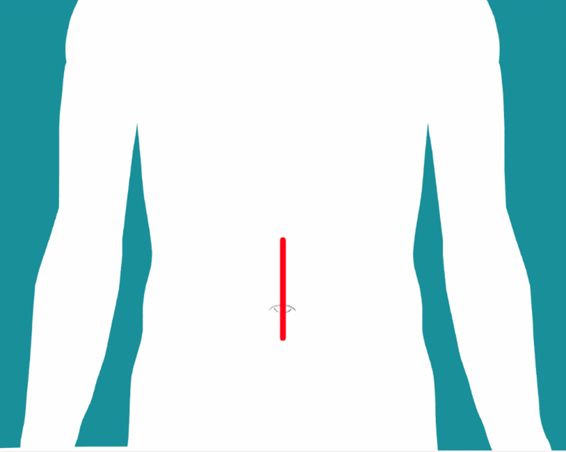 Hernia Repair Northern Light Health