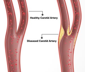Carotid-Artery-Disease.jpg