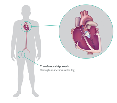 TAVR transfemoral approach