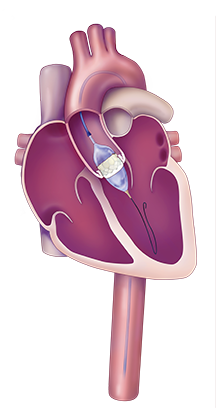 TAVR valve